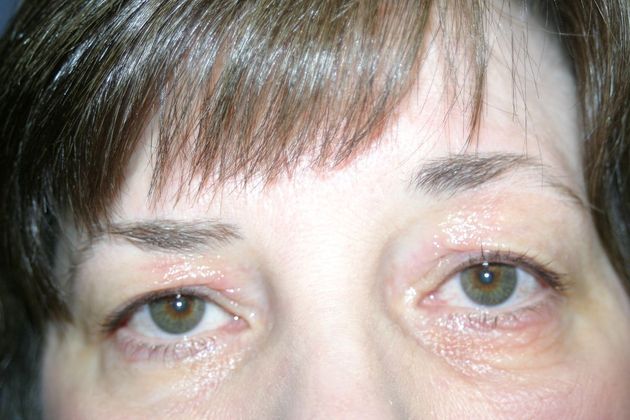 Blepharoplasty: Case 5 - Before