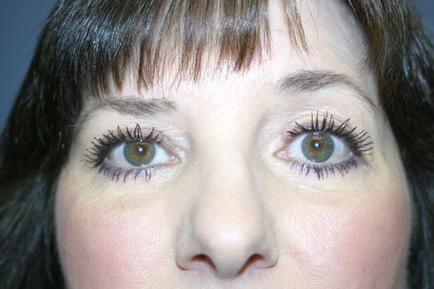 Blepharoplasty: Case 5 - After