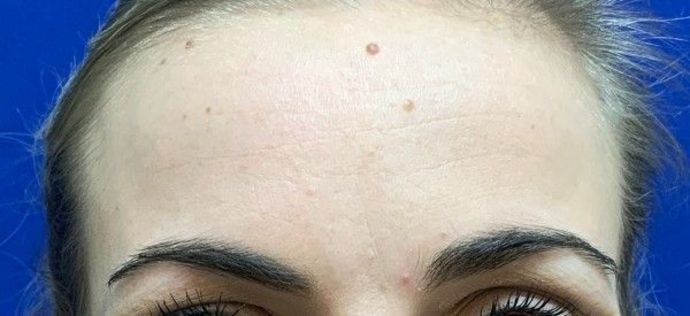 Injectables Botox, Dysport Neuromodulators: Case 2 (22830) - Before, resting & natural