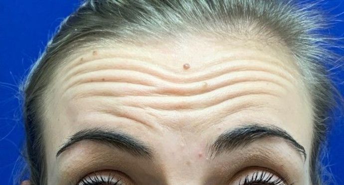 Injectables Botox, Dysport Neuromodulators Case 2 (22830) - Before