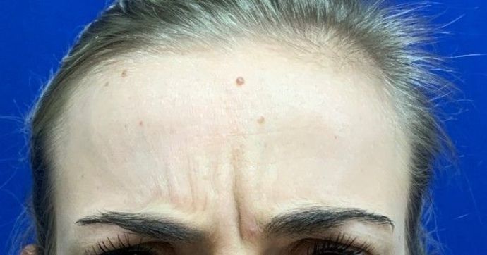 Injectables Botox, Dysport Neuromodulators: Case 2 (22830) - Before, frowning