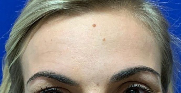 Injectables Botox, Dysport Neuromodulators: Case 2 (22830) - After, resting & natural