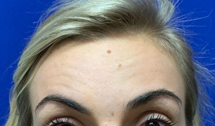 Injectables Botox, Dysport Neuromodulators Case 2 (22830) - After