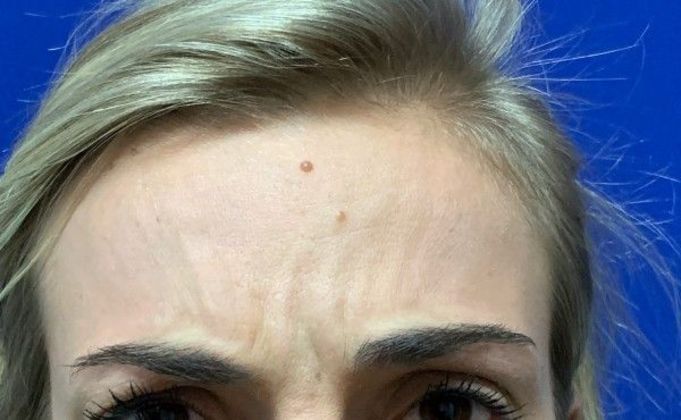 Injectables Botox, Dysport Neuromodulators: Case 2 (22830) - After, frown without deep lines