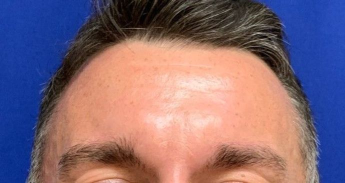 Injectables Botox, Dysport Neuromodulators: Case 3 (23258) - Before, smiling