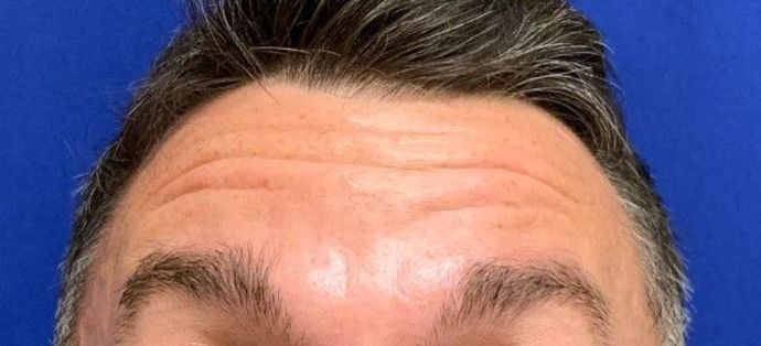 Injectables Botox, Dysport Neuromodulators: Case 3 (23258) - Before, lifting eyebrows