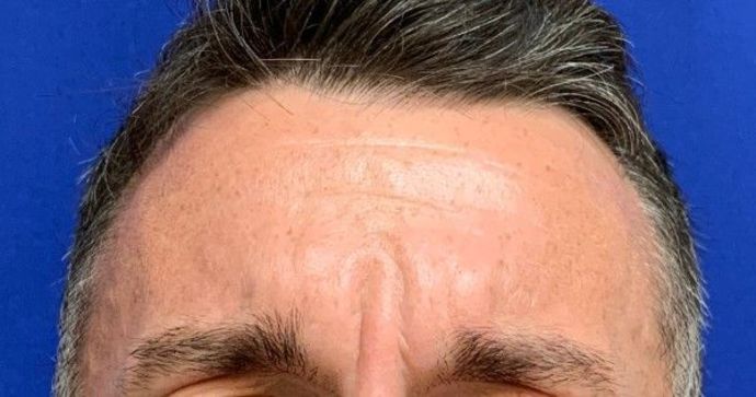 Injectables Botox, Dysport Neuromodulators Case 3 (23258) - Before