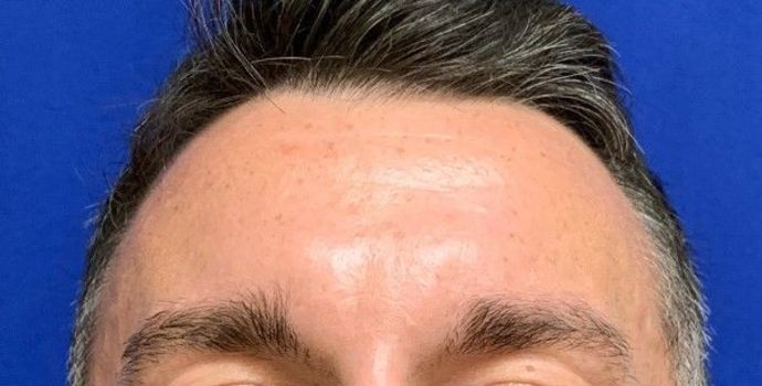 Injectables Botox, Dysport Neuromodulators: Case 3 (23258) - Before, resting expression