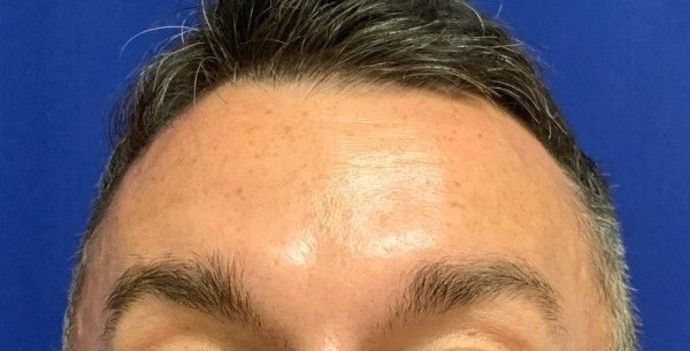 Injectables Botox, Dysport Neuromodulators: Case 3 (23258) - After, brows still lift, lines minimized