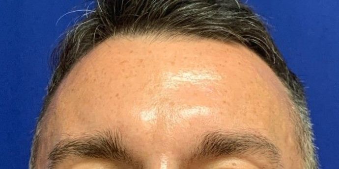 Injectables Botox, Dysport Neuromodulators: Case 3 (23258) - After treatment, smiling