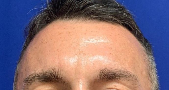 Injectables Botox, Dysport Neuromodulators Case 3 (23258) - After