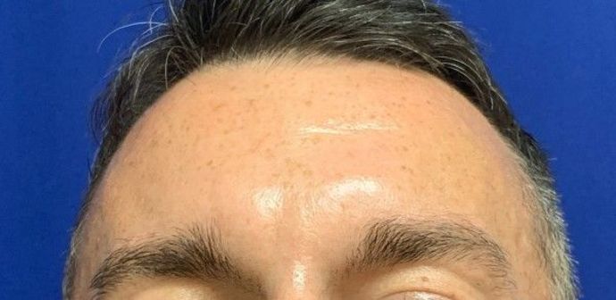 Injectables Botox, Dysport Neuromodulators: Case 3 (23258) - After, unchanged