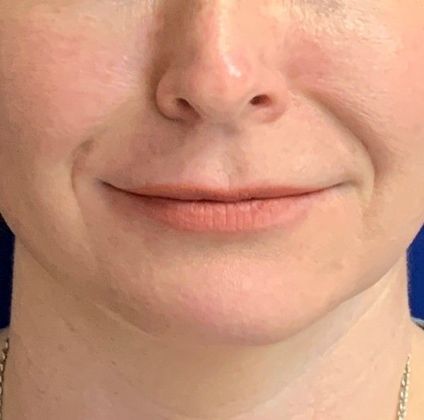 Injectables Botox, Dysport Neuromodulators: Case 4 (17745) - Before, lip filler
