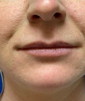 Injectables Botox, Dysport Neuromodulators Case 4 (17745) - Before