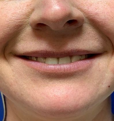 Injectables Botox, Dysport Neuromodulators: Case 4 (17745) - Before Botox