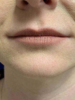 Injectables Botox, Dysport Neuromodulators: Case 4 (17745) - After, Vollure HA lip filler