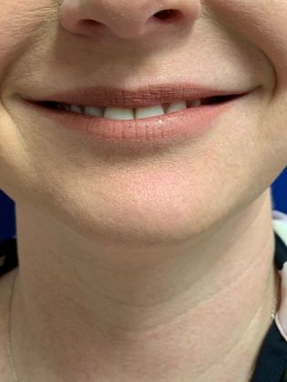 Injectables Botox, Dysport Neuromodulators: Case 4 (17745) - After lip flip