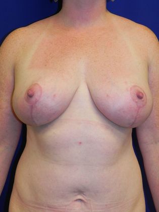 Body Mommy Make-Over: Case 7 (17745) - After, lift-reduction