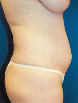 Body Mommy Make-Over Case 7 (17745) - Before