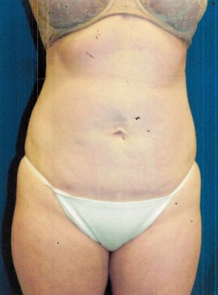 Body Tummy Tuck / Abdominoplasty Case 18 (17745) - After