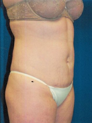 Body Tummy Tuck / Abdominoplasty: Case 18 (17745) - After