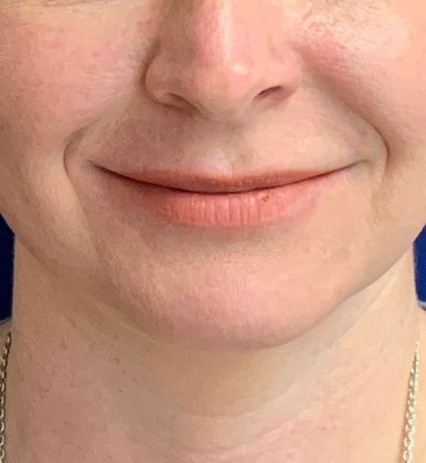 Injectables Minimally-Invasive / Fillers: Case 17 (17745) - Before