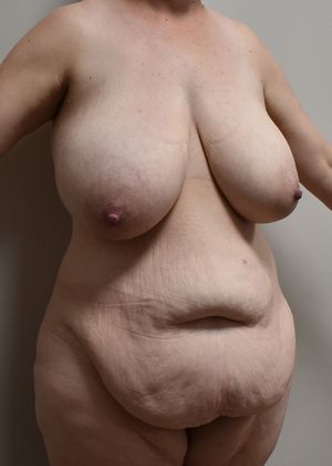 Massive Weight Loss : Case 59 - Before