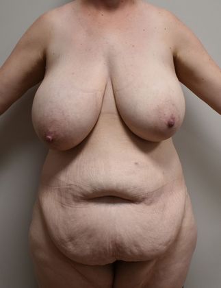 Massive Weight Loss : Case 59 - Before
