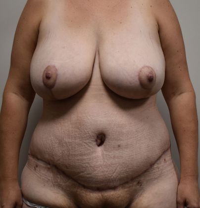 Massive Weight Loss : Case 59 - After