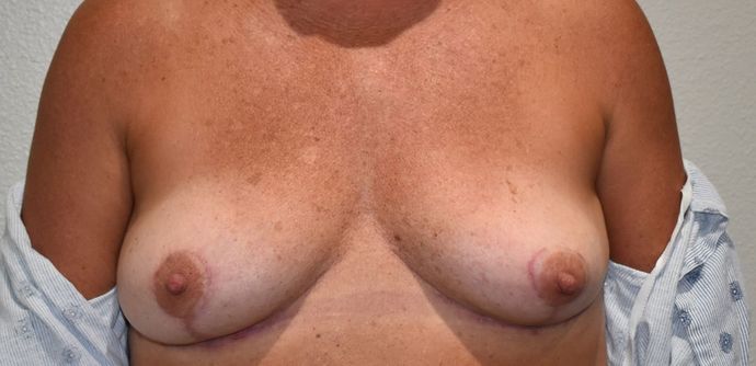 Breast Revision: Case 121 - After