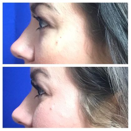 Injectables Minimally-Invasive / Fillers: Case 18 (21869) - Before & after
