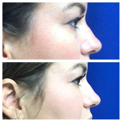 Injectables Minimally-Invasive / Fillers: Case 18 (21869) - Before & after