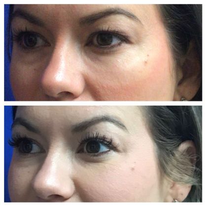 Injectables Minimally-Invasive / Fillers: Case 18 (21869) - Before above, after below