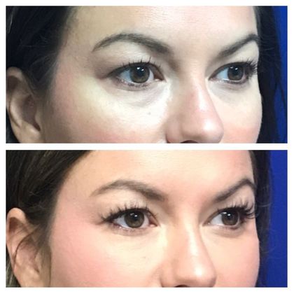 Injectables Minimally-Invasive / Fillers: Case 18 (21869) - Before above, after below