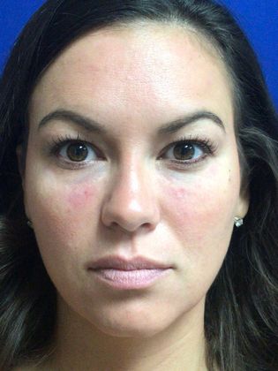 Injectables Minimally-Invasive / Fillers: Case 18 (21869) - Before
