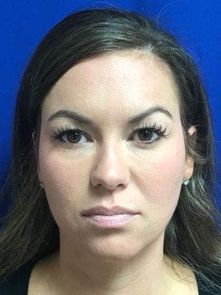 Injectables Minimally-Invasive / Fillers: Case 18 (21869) - After