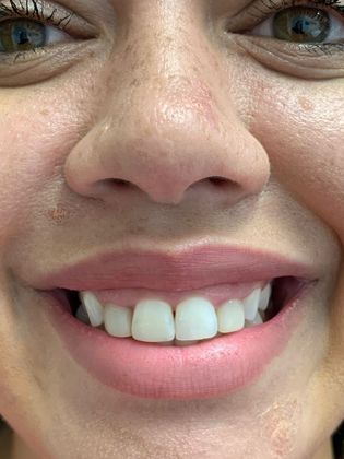 Injectables Botox, Dysport Neuromodulators Case 6 (20201) - Before