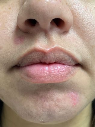 Injectables Botox, Dysport Neuromodulators: Case 6 (20201) - After, at rest