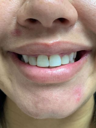 Injectables Botox, Dysport Neuromodulators Case 6 (20201) - After