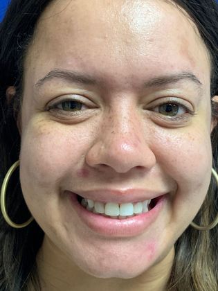 Injectables Botox, Dysport Neuromodulators: Case 6 (20201) - After Botox