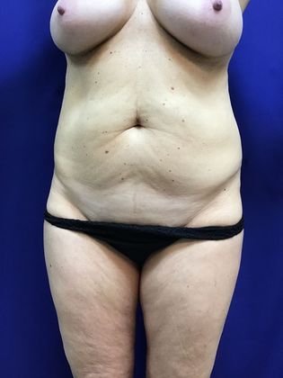 Breast Lift / Mastopexy: Case 33 (23063) - Before