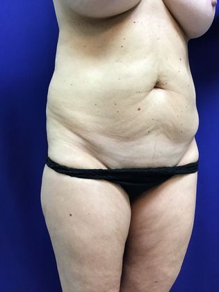 Body Mommy Make-Over: Case 8 (23063) - Before