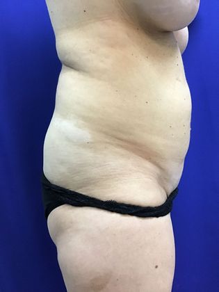 Body Mommy Make-Over: Case 8 (23063) - Before