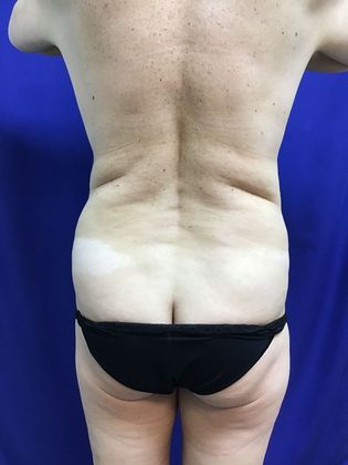 Body Mommy Make-Over: Case 8 (23063) - Before