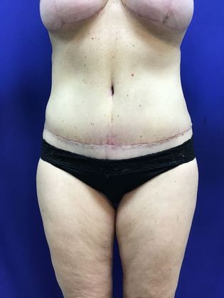 Body Mommy Make-Over Case 8 (23063) - After