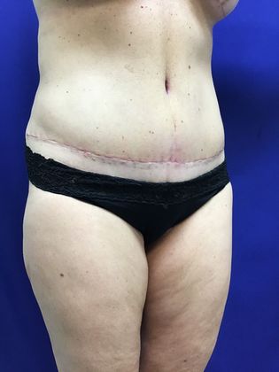 Body Mommy Make-Over: Case 8 (23063) - After