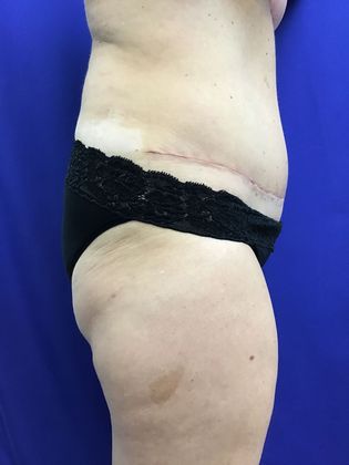 Body Mommy Make-Over: Case 8 (23063) - After