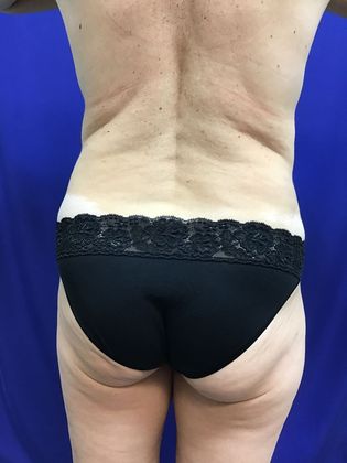 Body Mommy Make-Over: Case 8 (23063) - After, lipo improved flank curve, more hour-glass