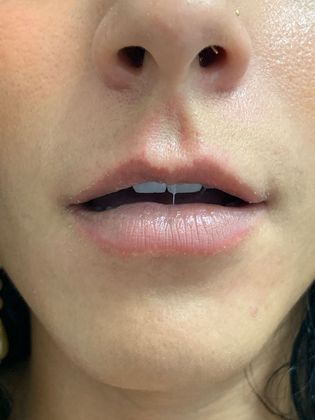 Injectables Minimally-Invasive / Fillers: Case 19 (21274) - Two weeks after, swelling gone