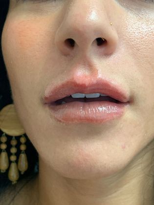 Injectables Minimally-Invasive / Fillers: Case 19 (21274) - Immediately after, normal swelling